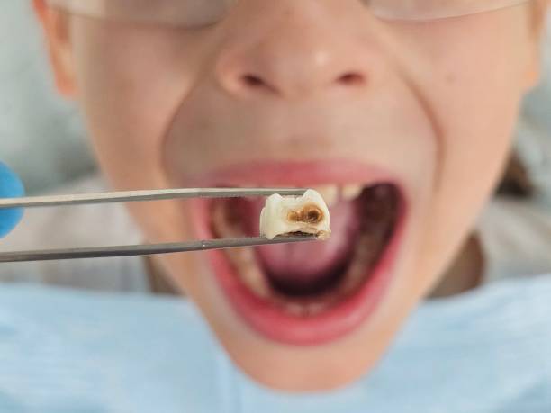 Best Dentist for Tooth Abscess  in Asotin, WA